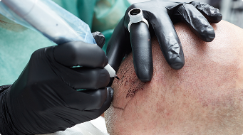 Scalp Micropigmentation